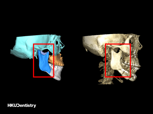Sagittal split ramus osteotomy (SSRO): (Left) The pre-operative virtual surgical planning (red frame); (Right) The post-operative CT scan showing the fixation with titanium plate and screws (red frame).
 